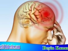 Beyin Kanaması Nedir, Belirtileri Nelerdir?