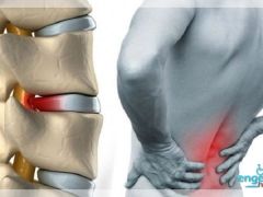 Bel ve Boyun Fıtığı Ameliyatları